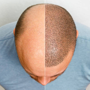 Hair Transplant Design